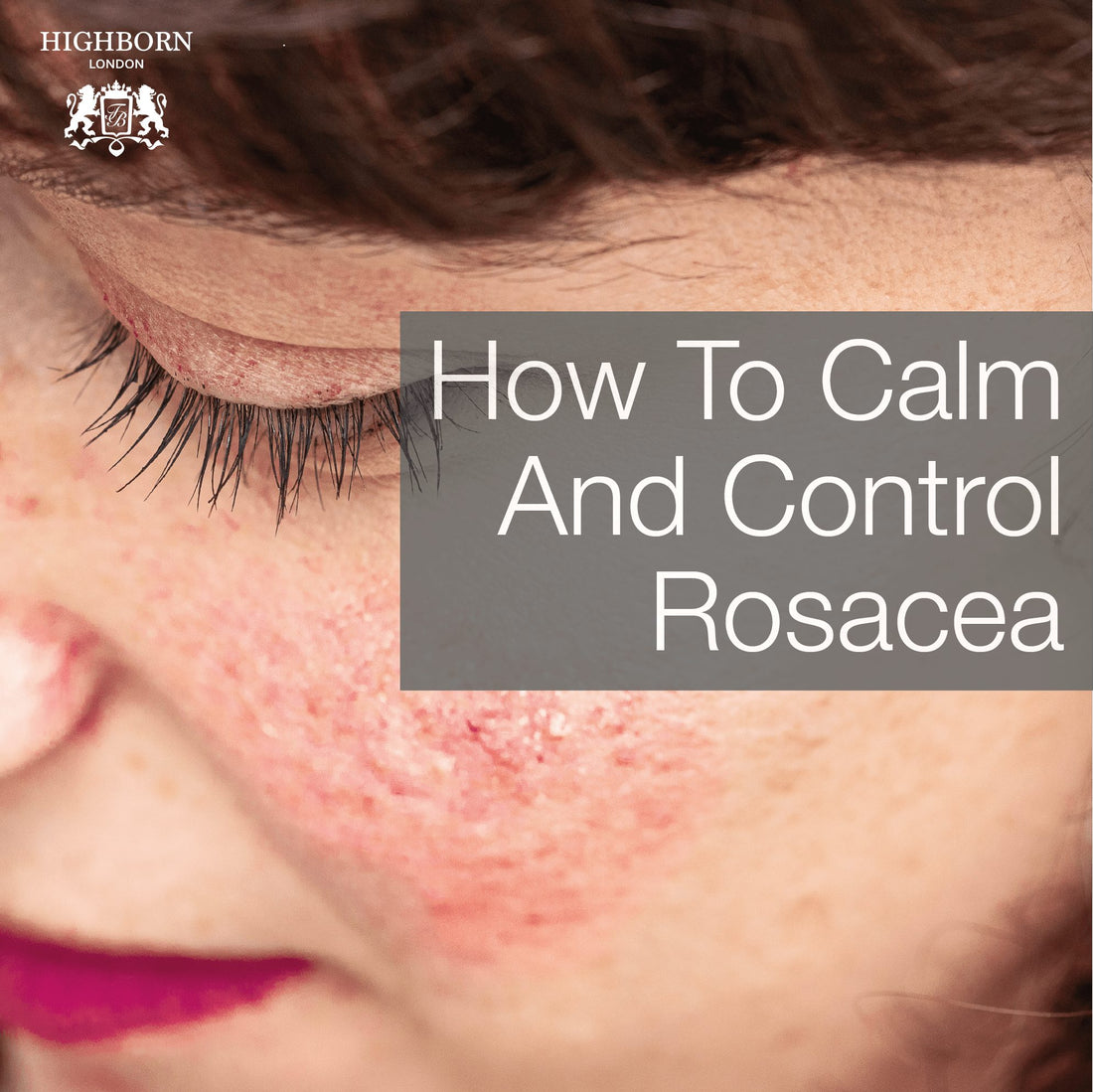 Rosacea: What It Is & How Best To Treat It Highborn London Rosacea: What It Is & How Best To Treat It Highborn London